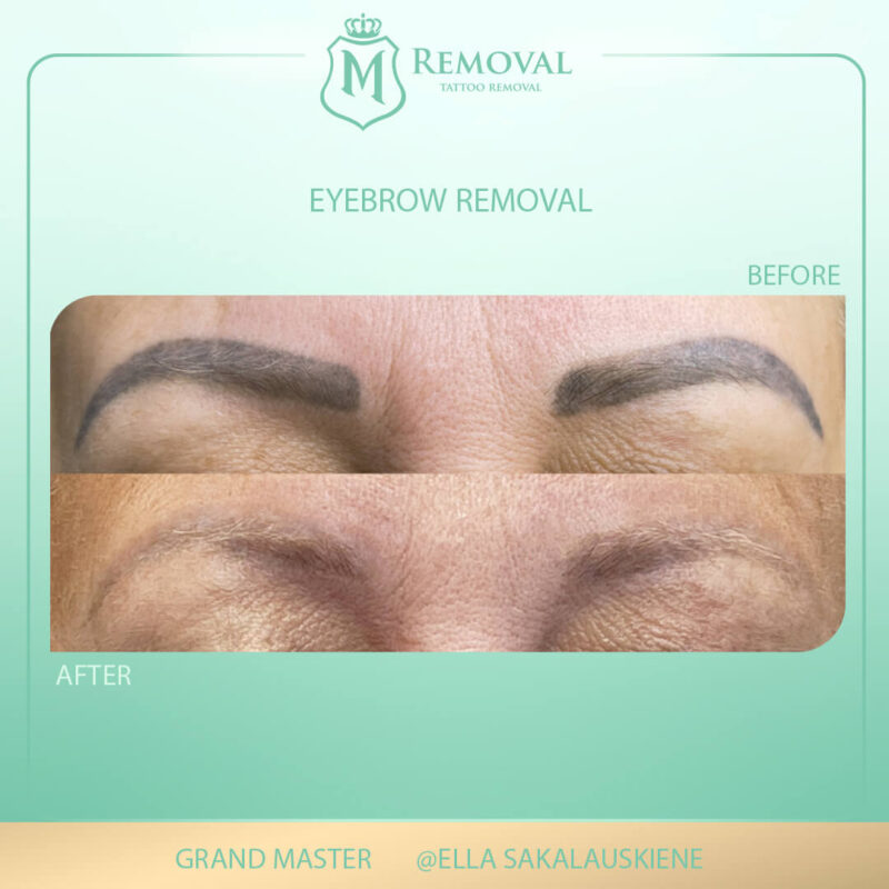 Eyebrow removal (1)