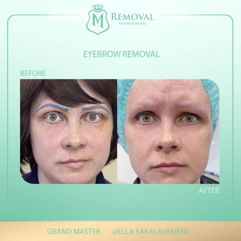 Eyebrow removal01