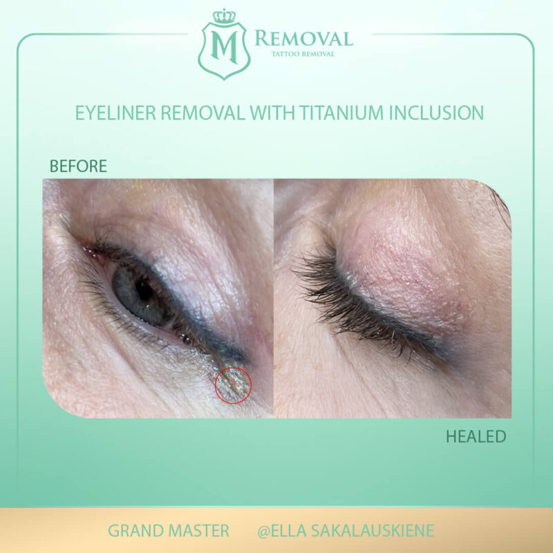 Eyeliner removal with titanium inclusion