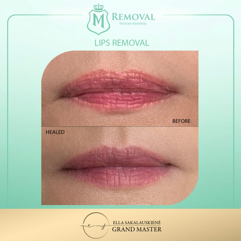 Lip MRemoval