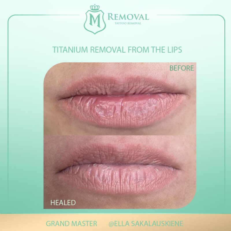 Titanium removal from the lips_1_Ella (1)