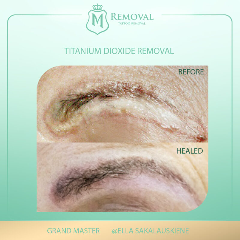 Titanium dioxide removal