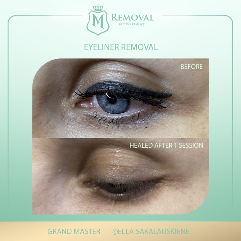 m removal_ EYELINER removal1_Ella