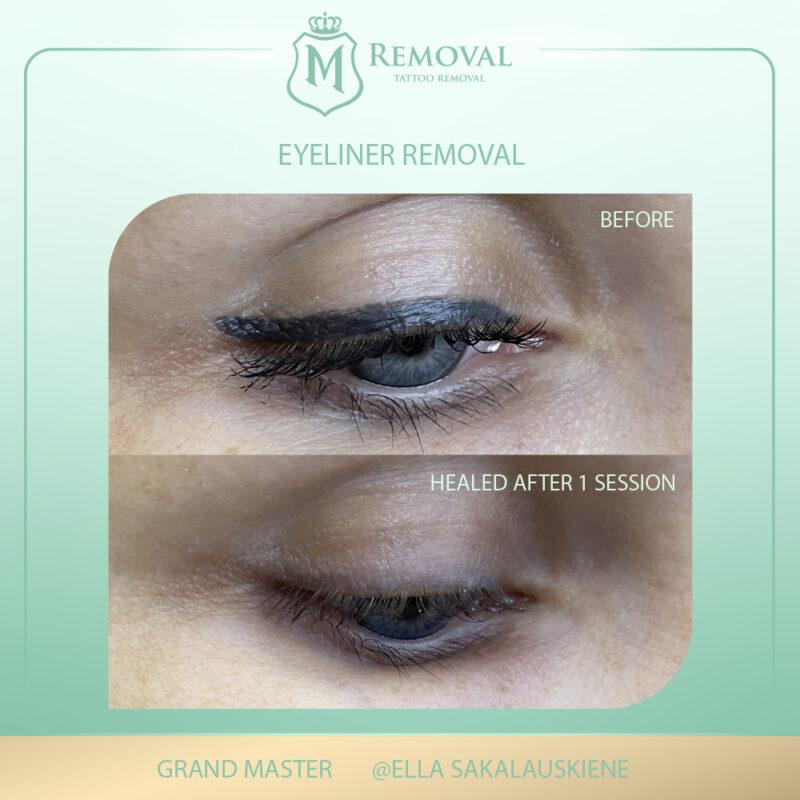 m removal_ EYELINER removal_Ella