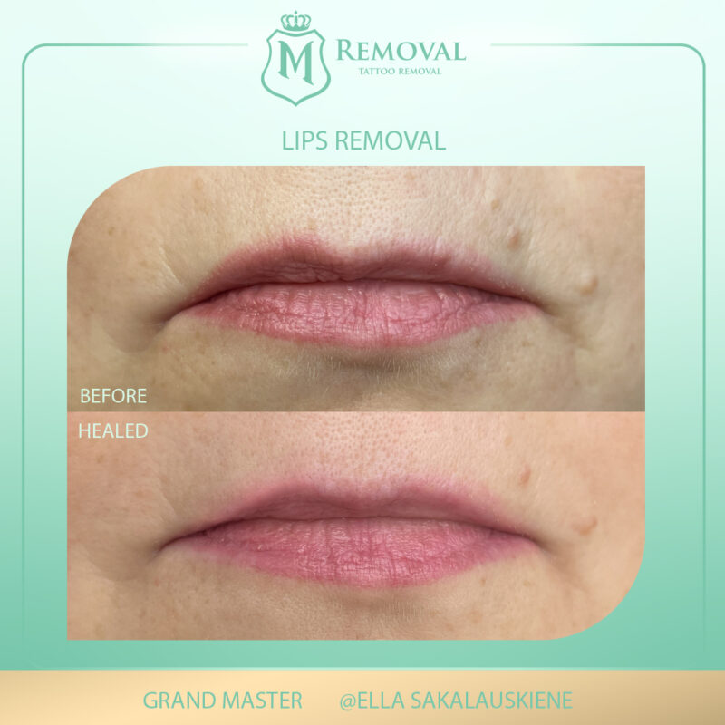 m removal_lips_ella01 (1)