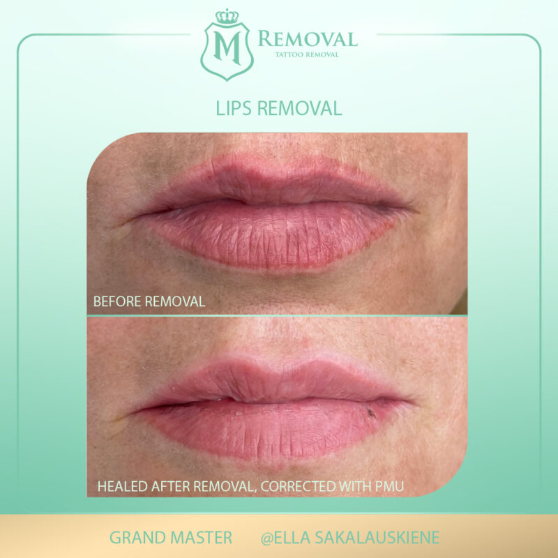 m removal_lips_ella01